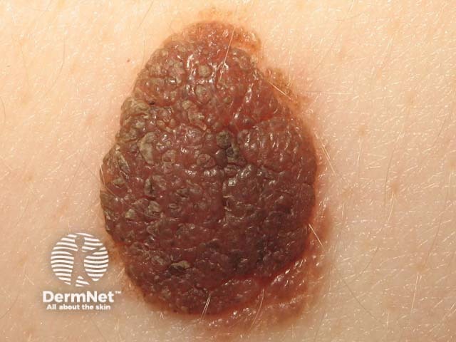 nevus image from DermNet