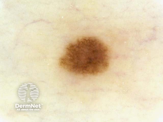 nevus image from DermNet