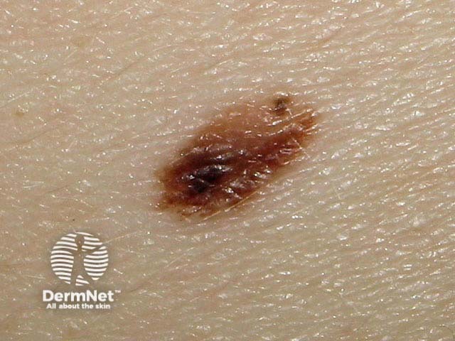 nevus image from DermNet