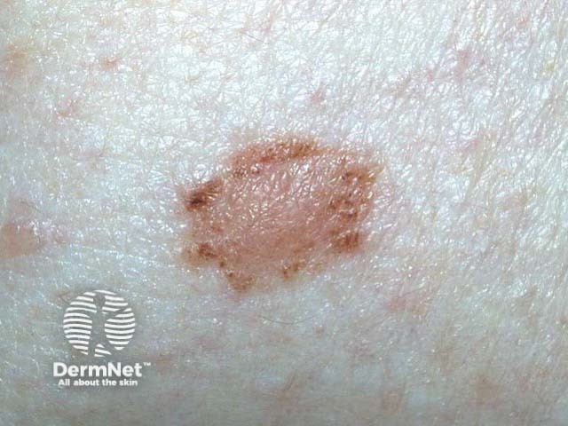 nevus image from DermNet
