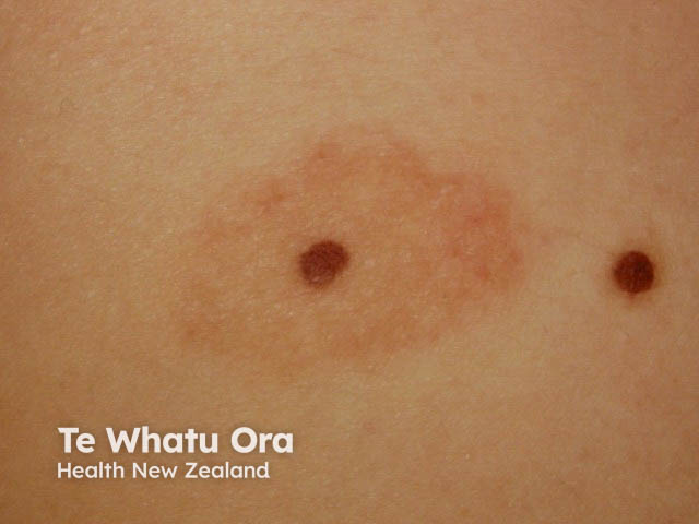 nevus image from DermNet