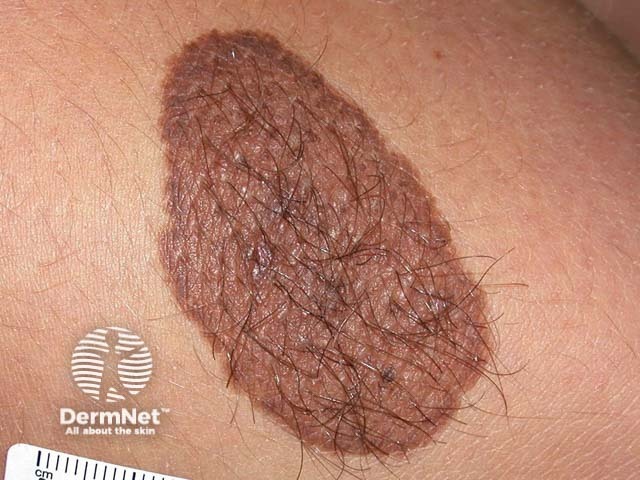 nevus image from DermNet