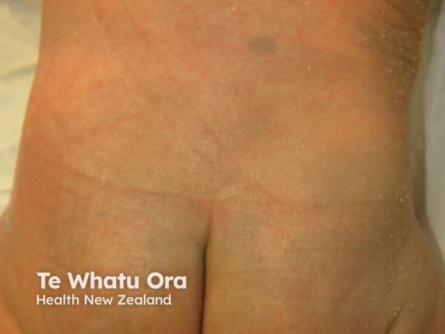 nevus image from DermNet