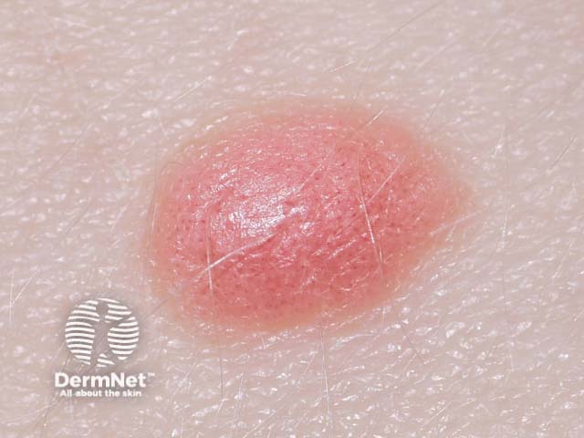 nevus image from DermNet