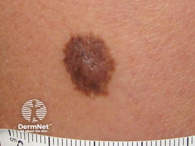 nevus image from DermNet
