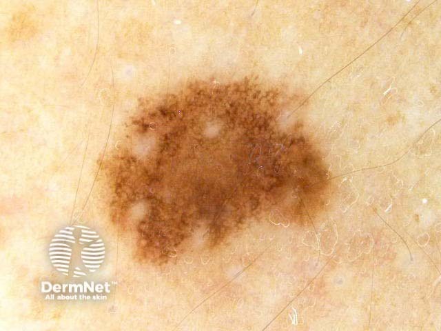 nevus image from DermNet