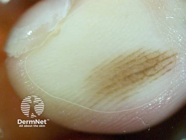 nevus image from DermNet