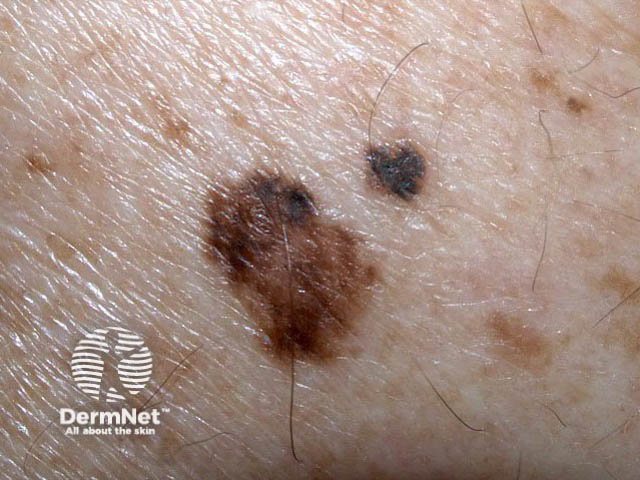 nevus image from DermNet