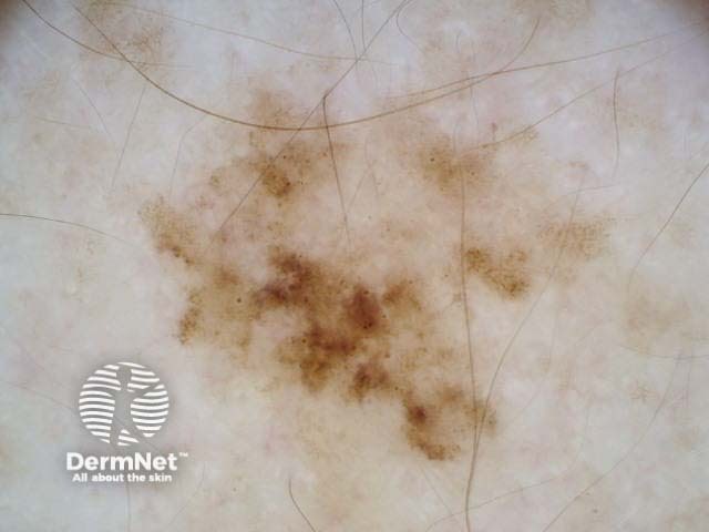 nevus image from DermNet