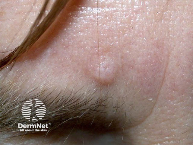 nevus image from DermNet