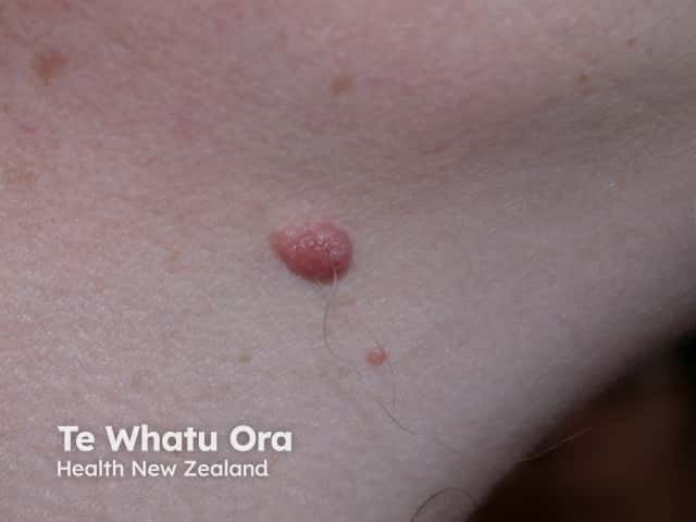 nevus image from DermNet