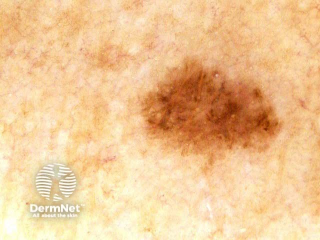 nevus image from DermNet