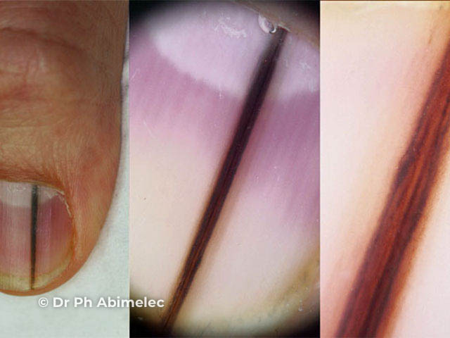 nevus image from DermNet