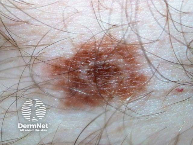 nevus image from DermNet