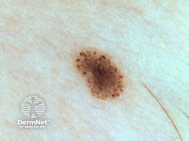 nevus image from DermNet