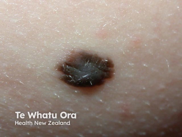 nevus image from DermNet