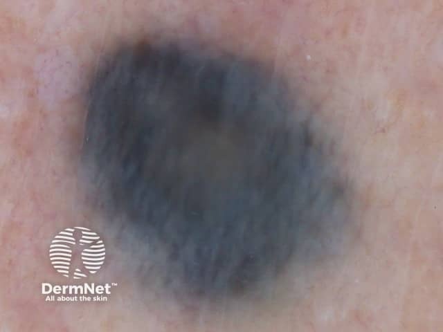 nevus image from DermNet
