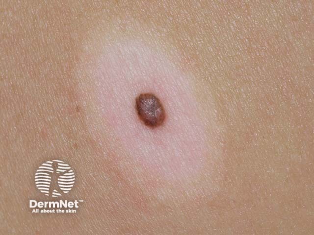 nevus image from DermNet