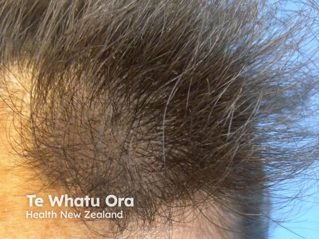 nevus image from DermNet