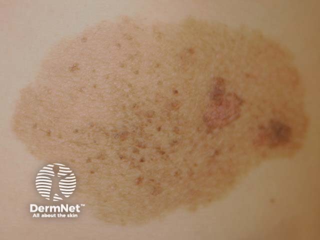 nevus image from DermNet