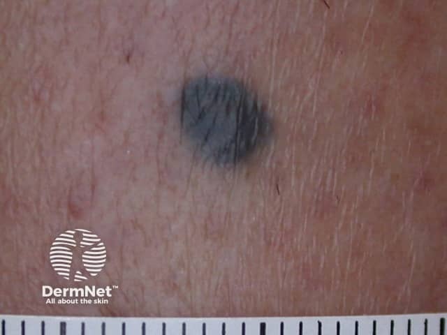 nevus image from DermNet