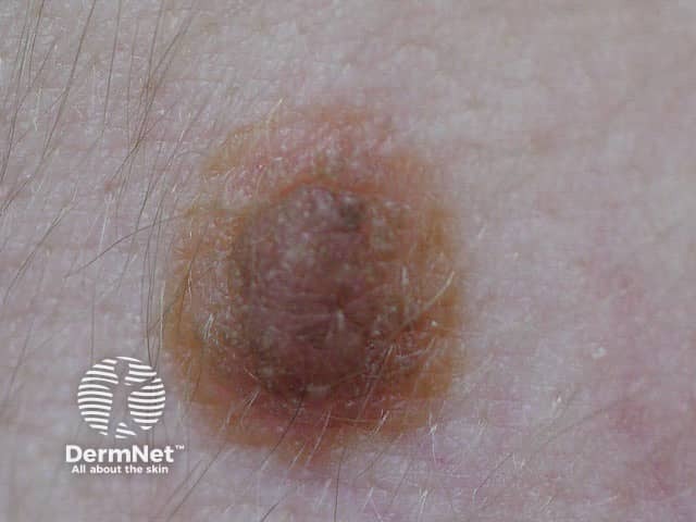 nevus image from DermNet