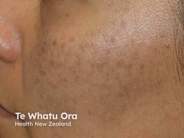 nevus image from DermNet