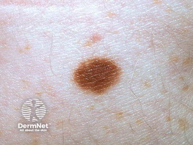 nevus image from DermNet
