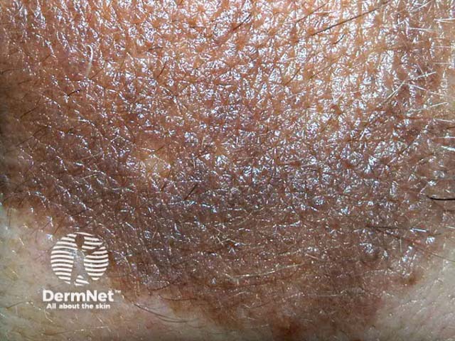 nevus image from DermNet