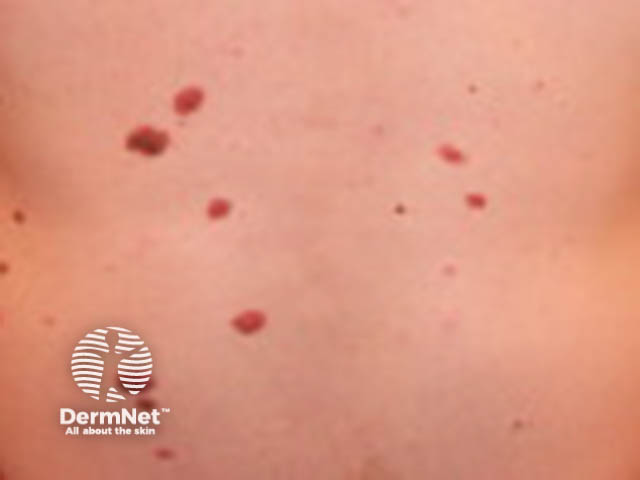 nevus image from DermNet
