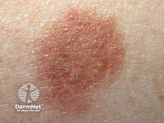 nevus image from DermNet