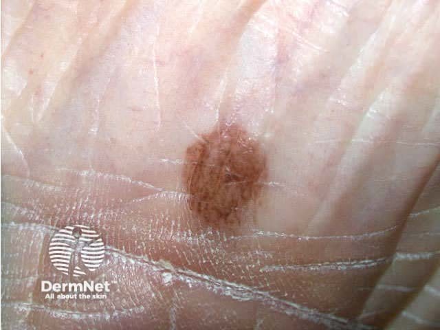 nevus image from DermNet