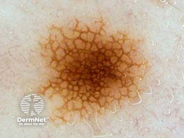 nevus image from DermNet