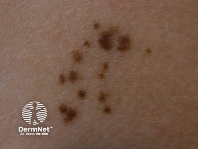 nevus image from DermNet