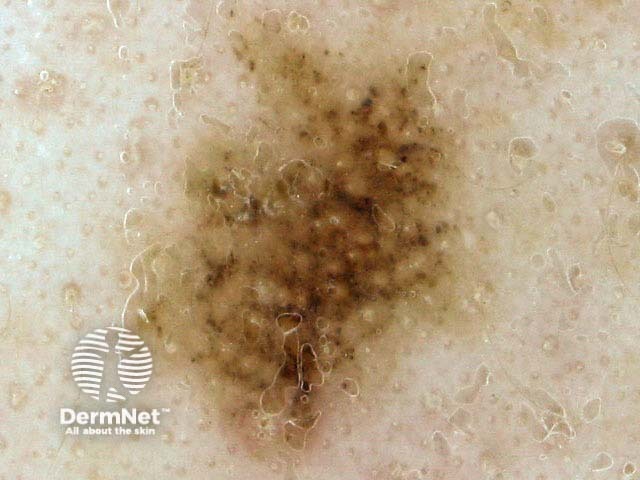 nevus image from DermNet