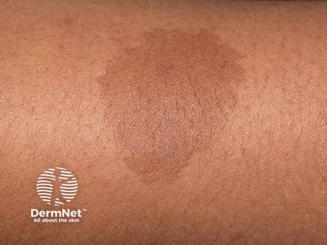 nevus image from DermNet