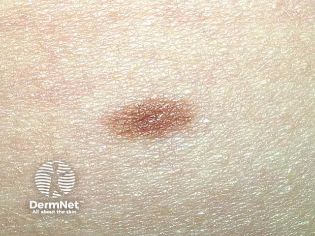 nevus image from DermNet