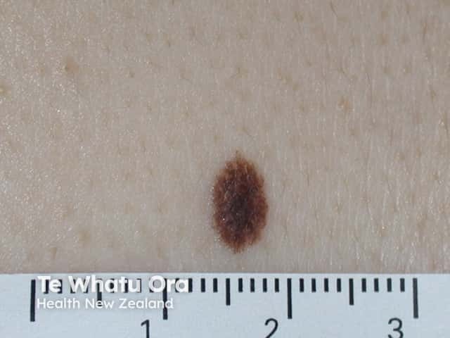 nevus image from DermNet