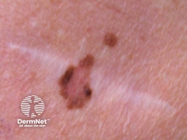 nevus image from DermNet