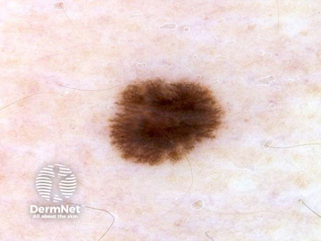 nevus image from DermNet