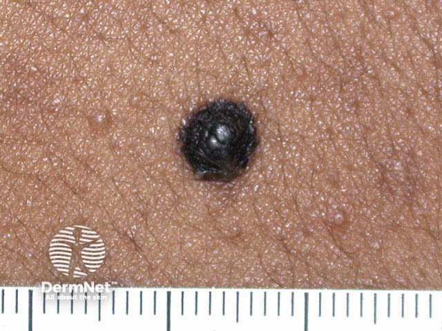 nevus image from DermNet