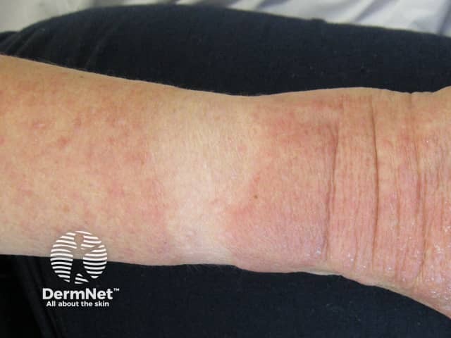 A photosensitive drug eruption showing sparing under the watch and strap