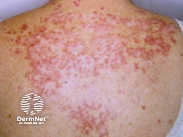 scle image from DermNet