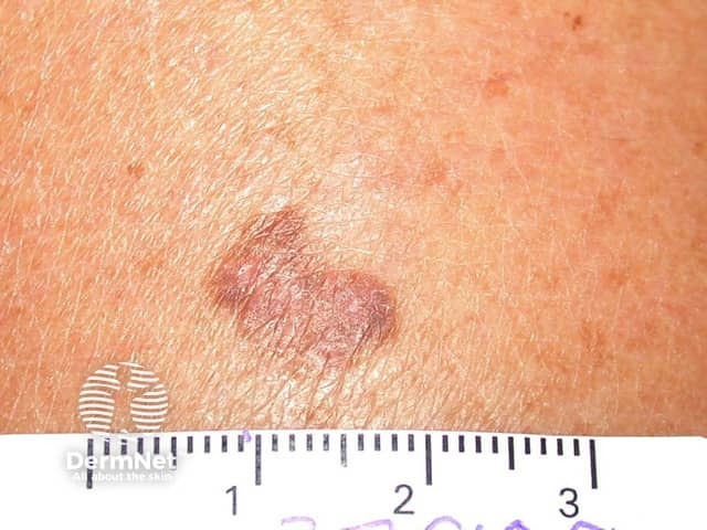 seborrheic-keratosis image from DermNet