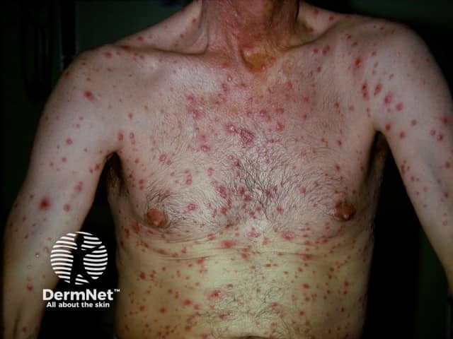 secondary-syphilis image from DermNet