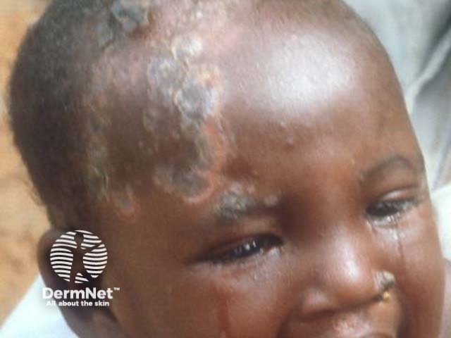 secondary-syphilis image from DermNet