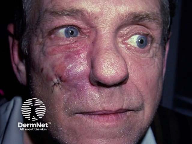 secondary-syphilis image from DermNet