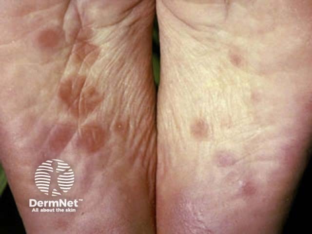 secondary-syphilis image from DermNet