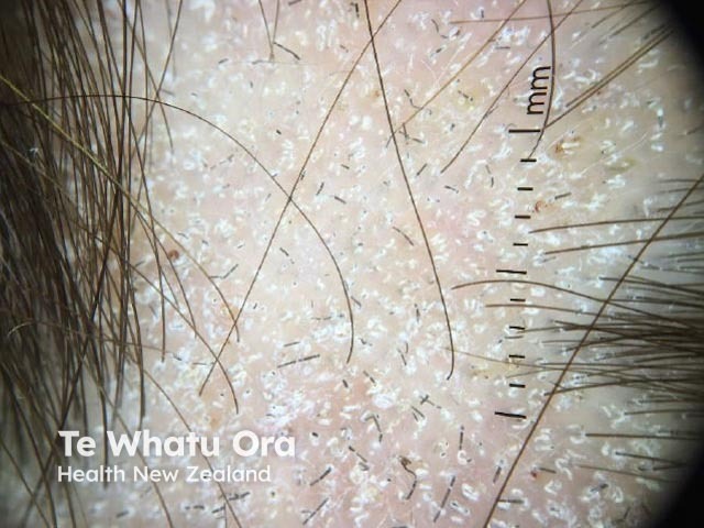 tinea-capitis image from DermNet