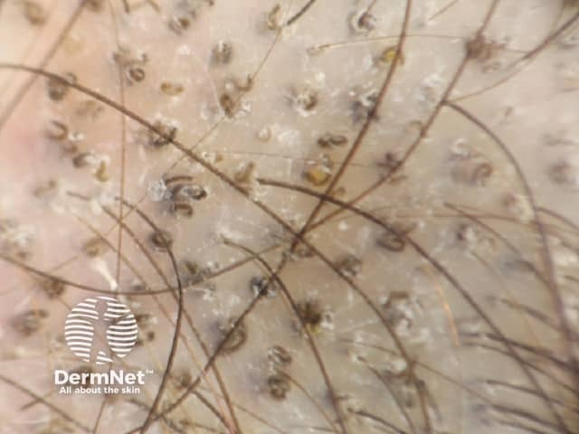 tinea-capitis image from DermNet